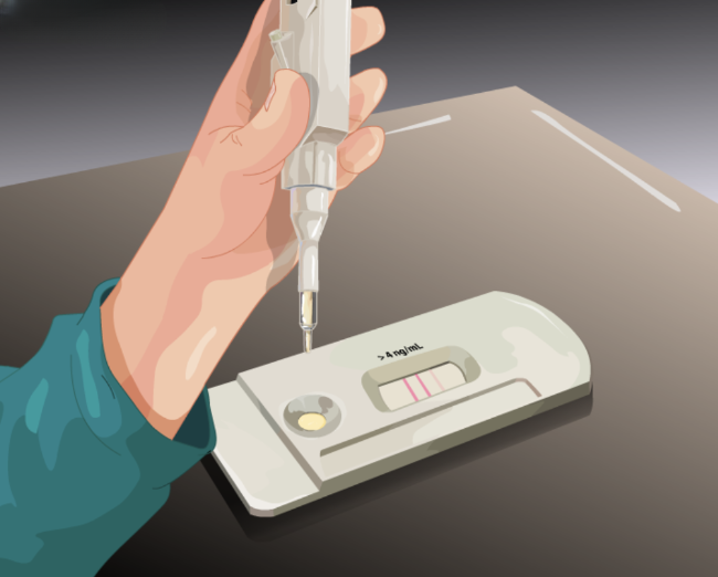 Prostate specific antigen (PSA)